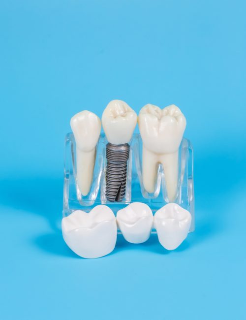 Plastic,Dental,Crowns,,Imitation,Of,A,Dental,Prosthesis,Of,A
