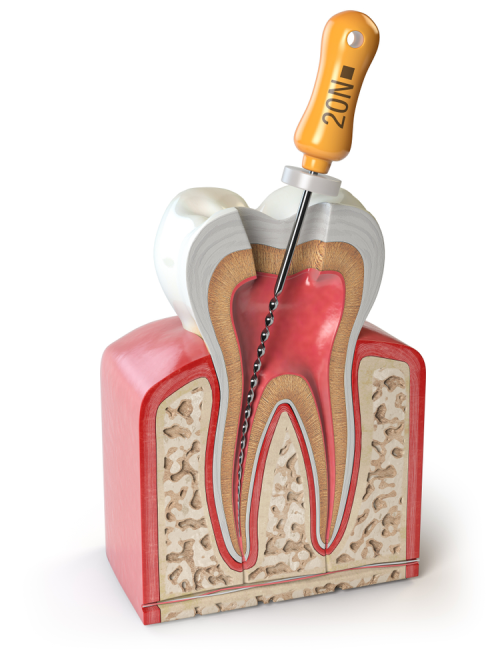 Root Canal Treatment-3