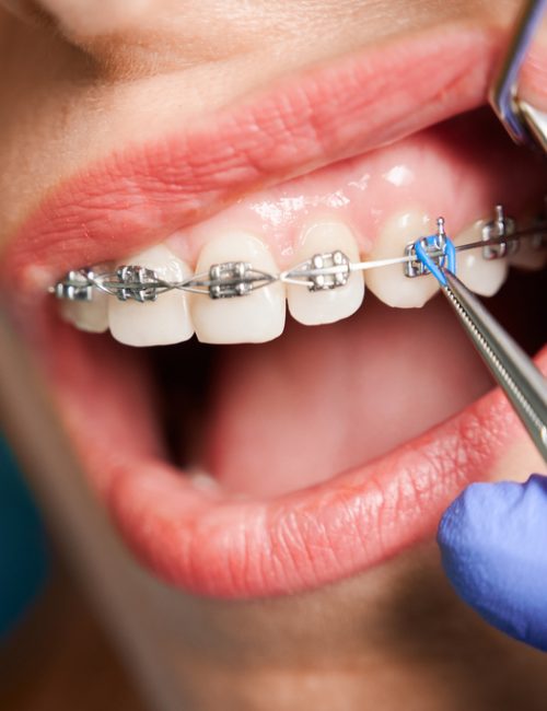 Close,Up,Of,Woman,With,Brackets,Receiving,Dental,Braces,Treatment