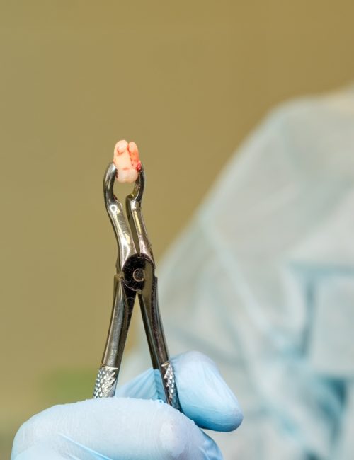 Hand,Of,Dentist,Surgeon,Holds,In,Forceps,A,Freshly,Removed